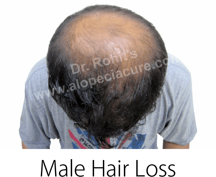 male hair loss